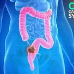 Colon Cancer Symptoms