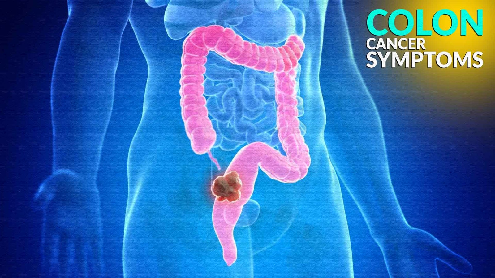 Colon Cancer Symptoms