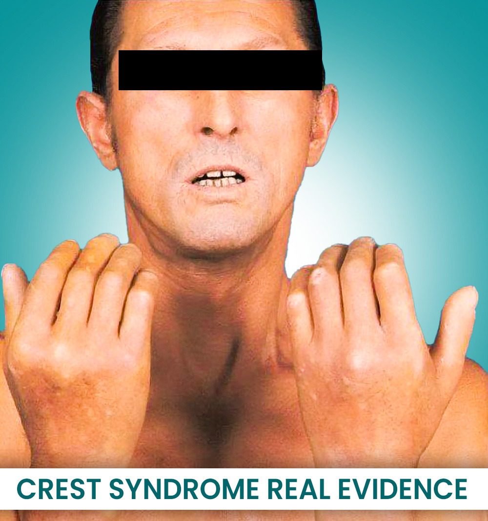 Crest Syndrome Real Evidence