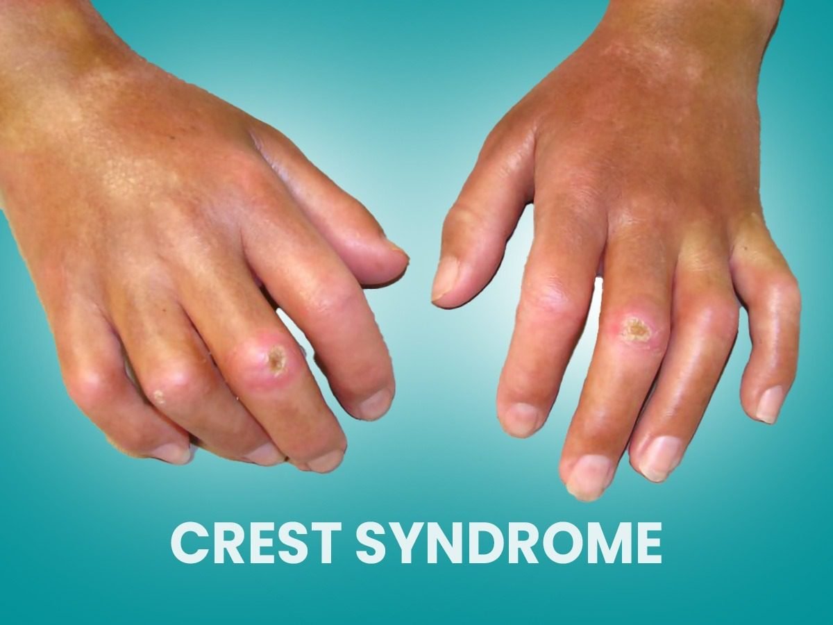 Crest Syndrome