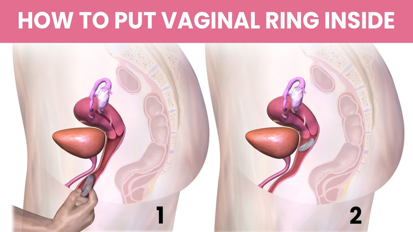 How to insert vaginal ring