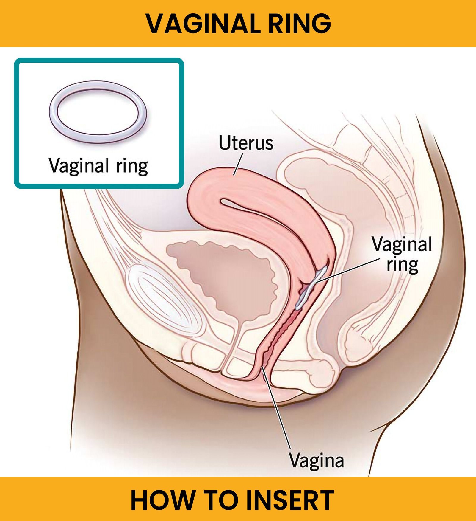 location of vaginal ring