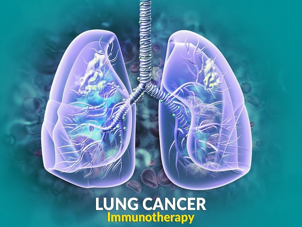 Lung Cancer Immunotherapy Treatment