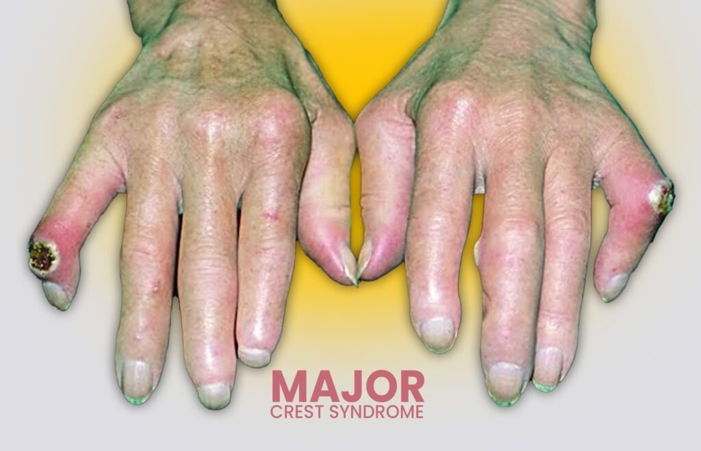 Major crest syndrome