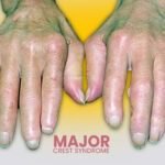 Major crest syndrome