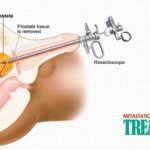 Prostate Cancer Treatment