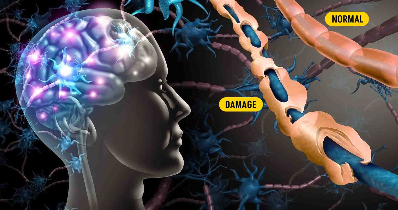 Multiple Sclerosis Normal and Damage human