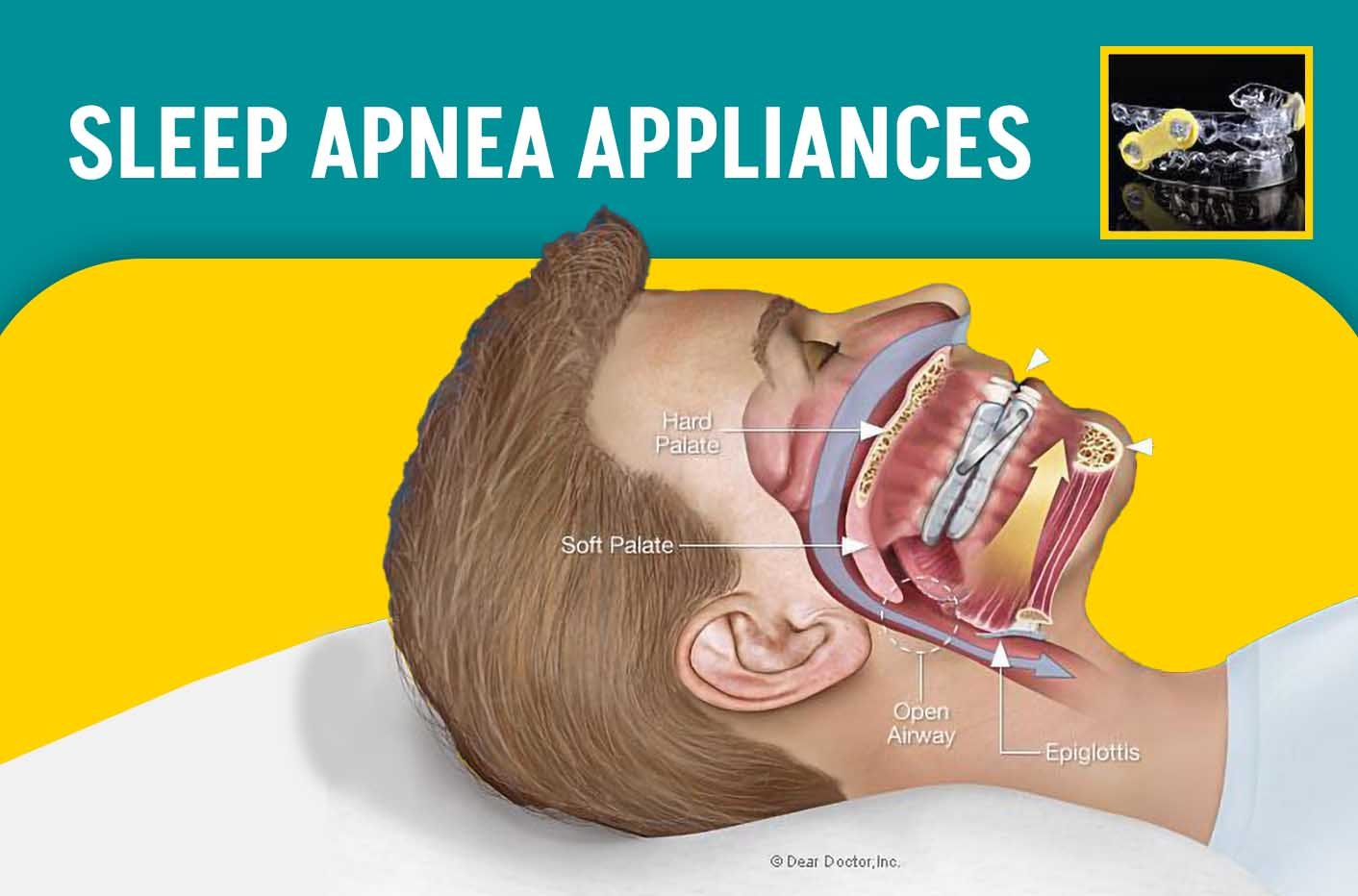 Sleep Apnea Appliances image