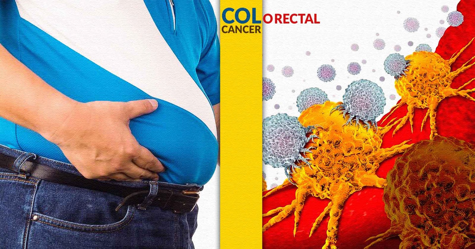 colorectal cancer Fatty man