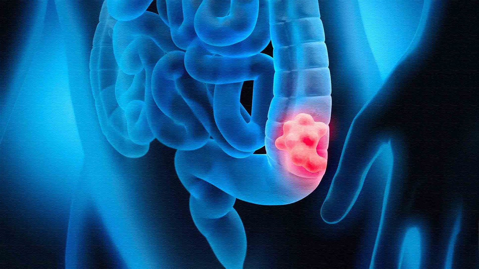 3d illustration of colon cancer tumor