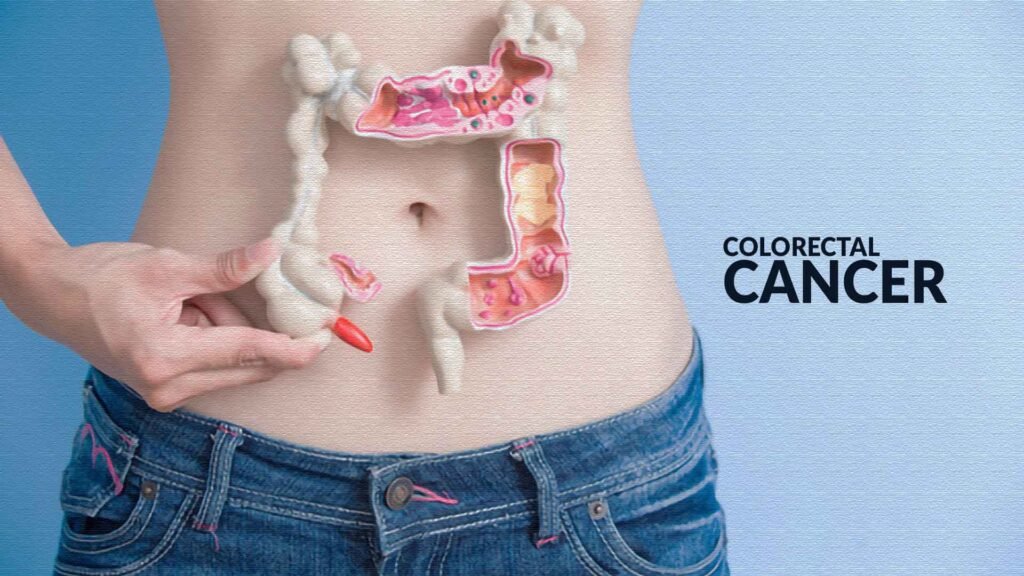 Colorectal Cancer