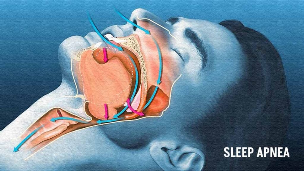 Sleep Apnea Appliances