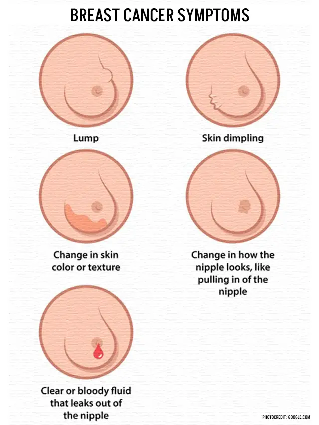 Breast Cancer Symptoms