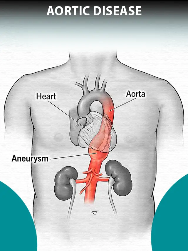 Aortic Disease