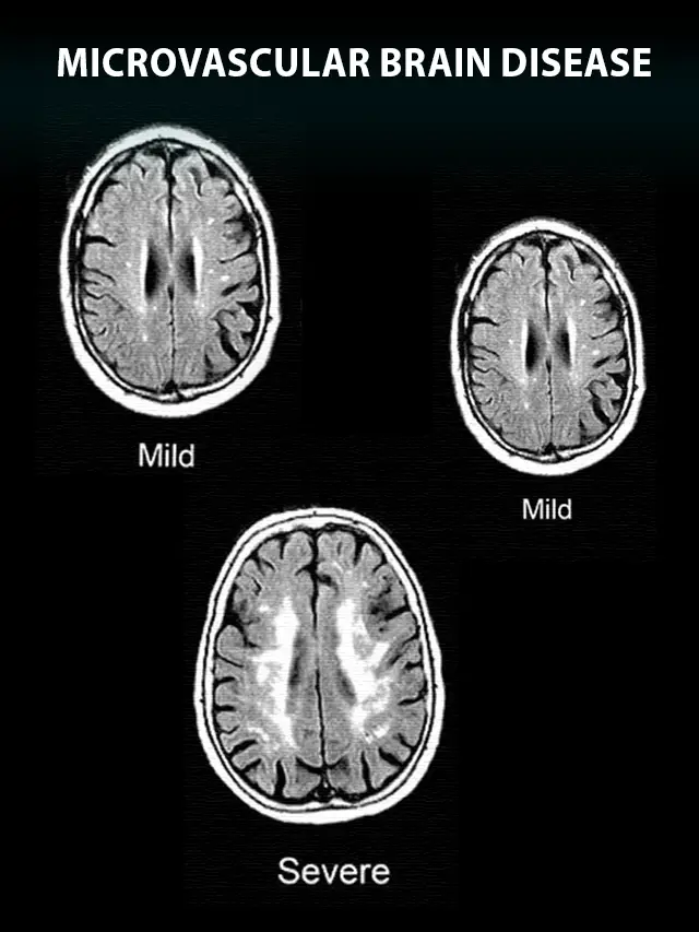 Unraveling Microvascular Brain Disease: Symptoms, Types, And Treatment ...