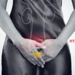 Hydronephrosis Symptoms And Kidney Complication