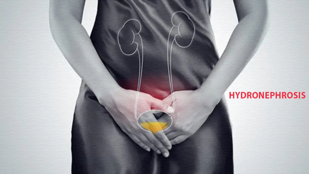 Hydronephrosis Symptoms And Kidney Complication