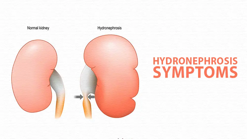 Hydronephrosis Symptoms And Signs