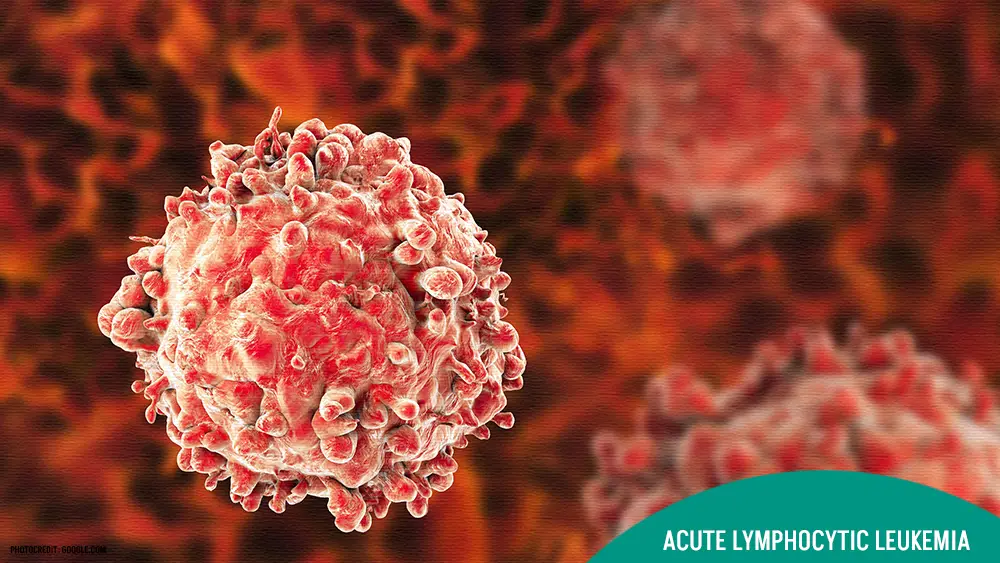 Acute Lymphocytic Leukemia