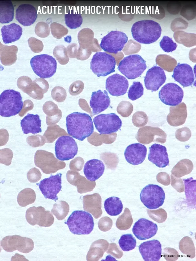 Acute Lymphocytic Leukemia