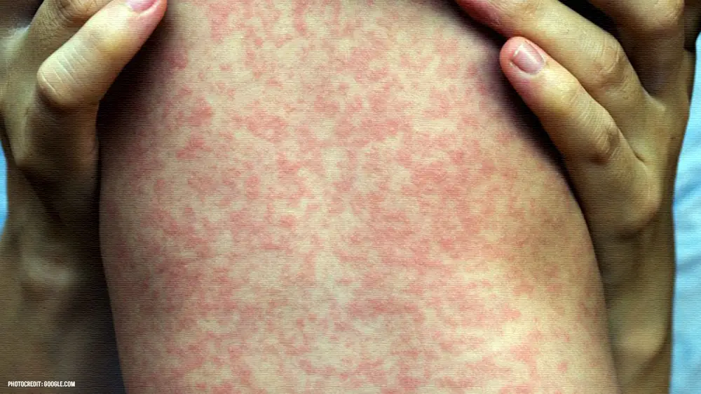 Measles Symptoms