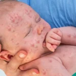 Measles Symptoms