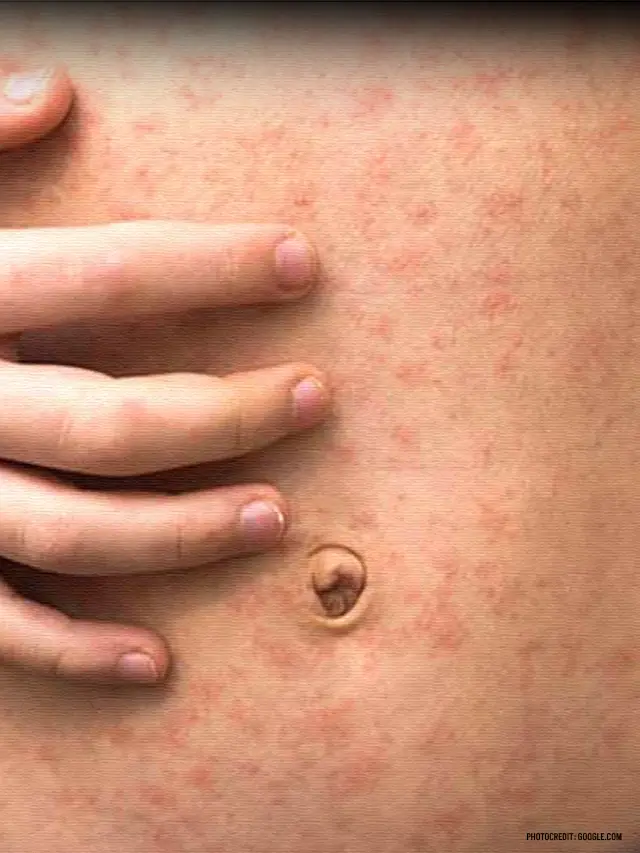 Measles Symptoms