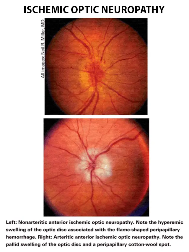 Ischemic Optic Neuropathy