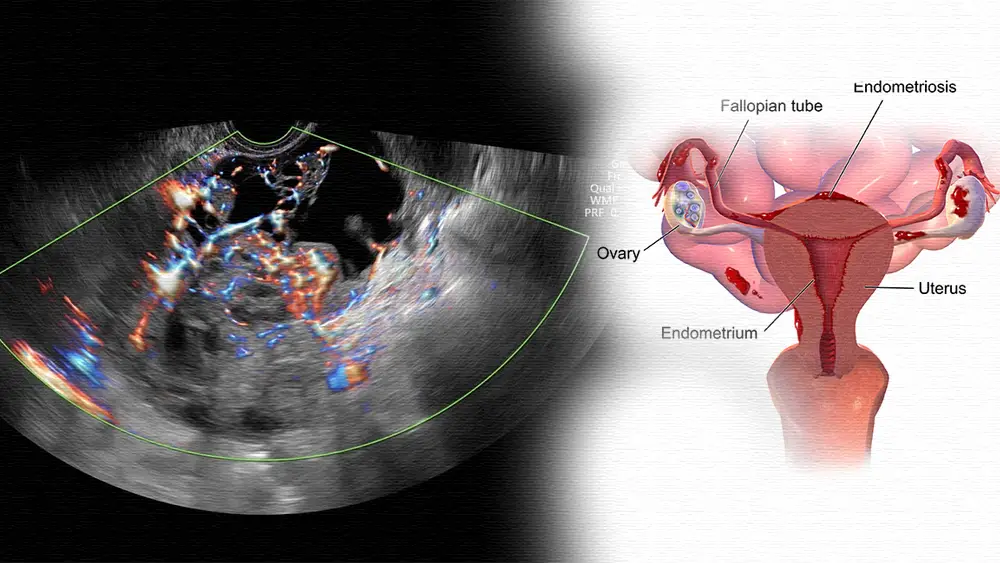 Ovarian Pain After Menopause