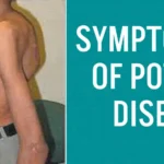 Potts Disease Symptoms and Causes