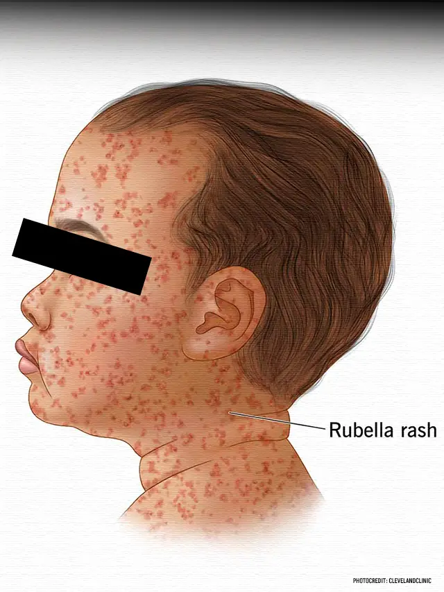 What Is Rubella