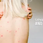 What does syphilis look like on a man and a woman?