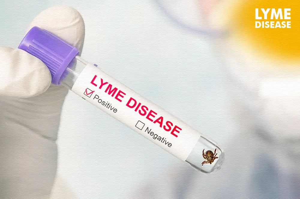 Lyme Disease Vaccine