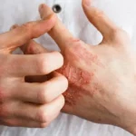 Eczema and Food Allergies