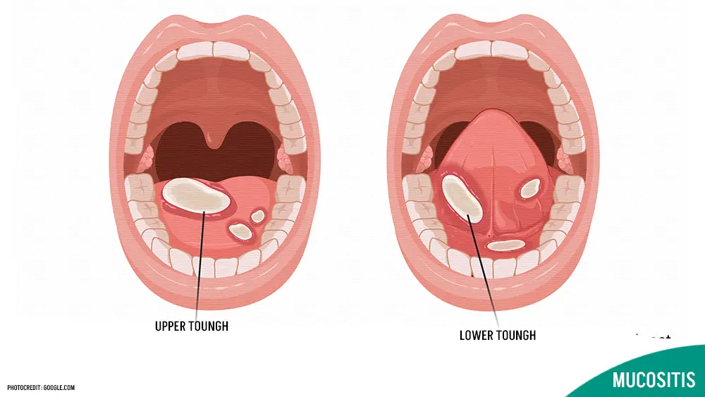 What is Mucositis