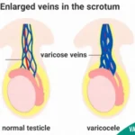 Varicocele Surgery Cost