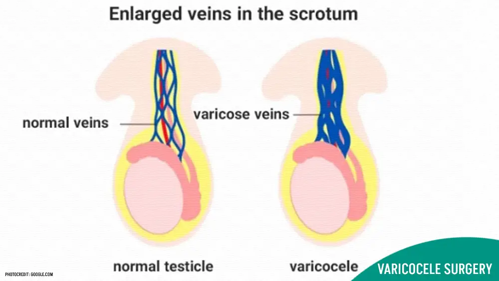 Varicocele Surgery Cost