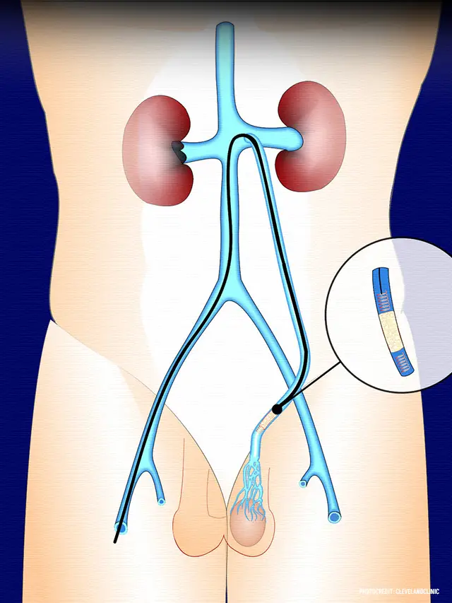 surgical varicocele treatment