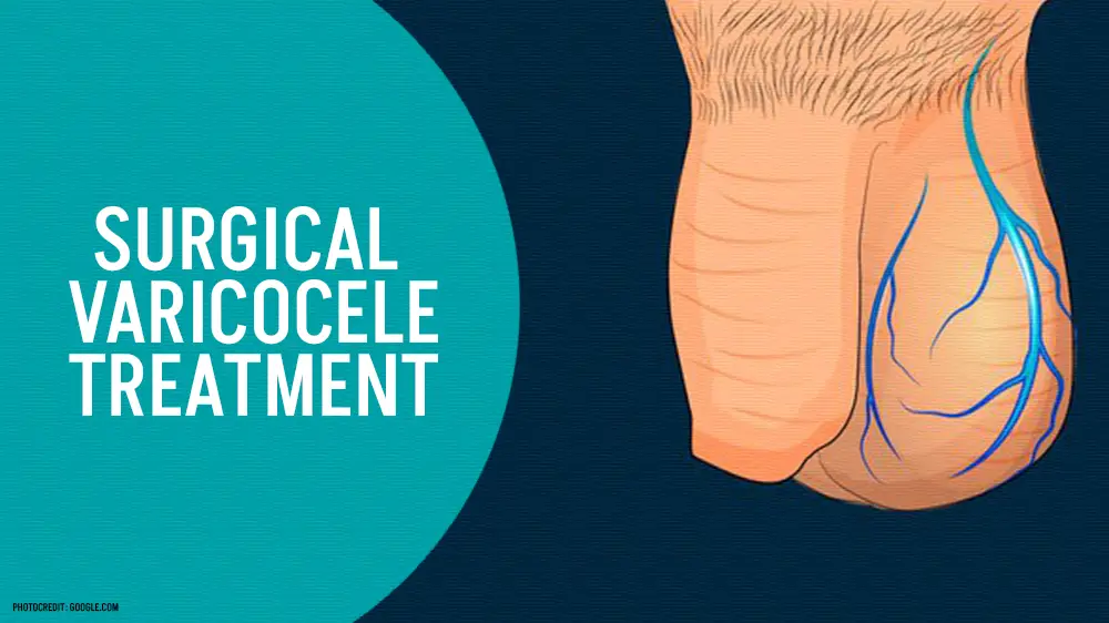 surgical varicocele treatment