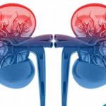 Acute Kidney Injury or AKI