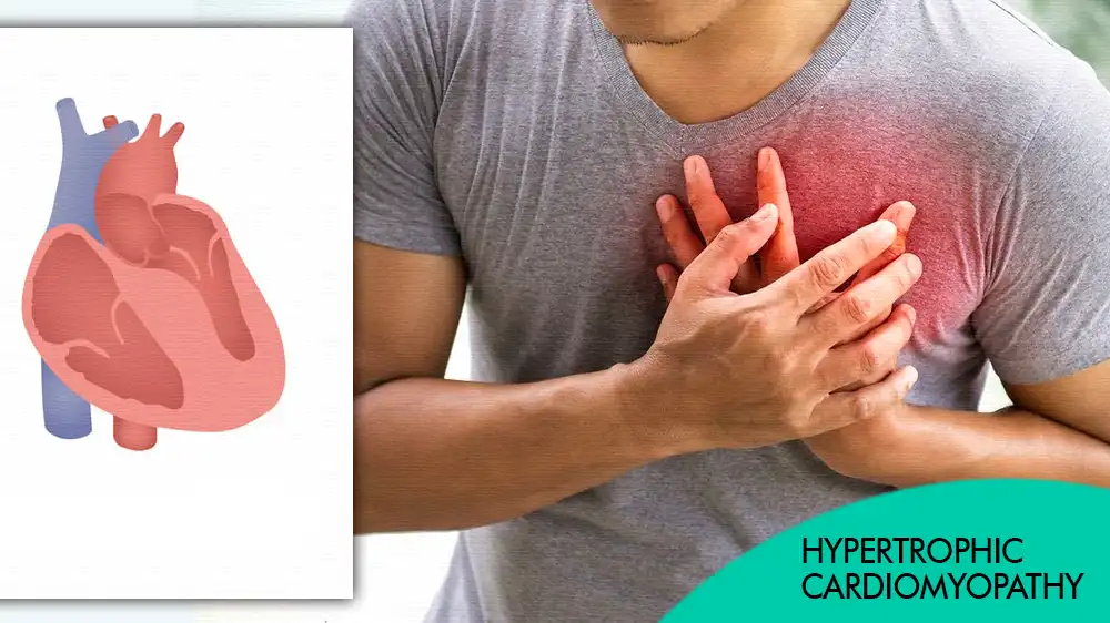 Hypertrophic Cardiomyopathy