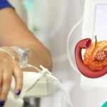 Pancreatic Cancer