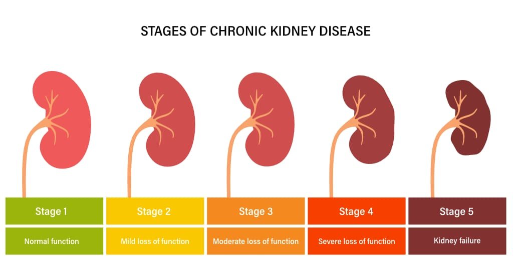 Chronic Kidney Disease