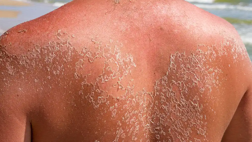 Sunburn Remedies