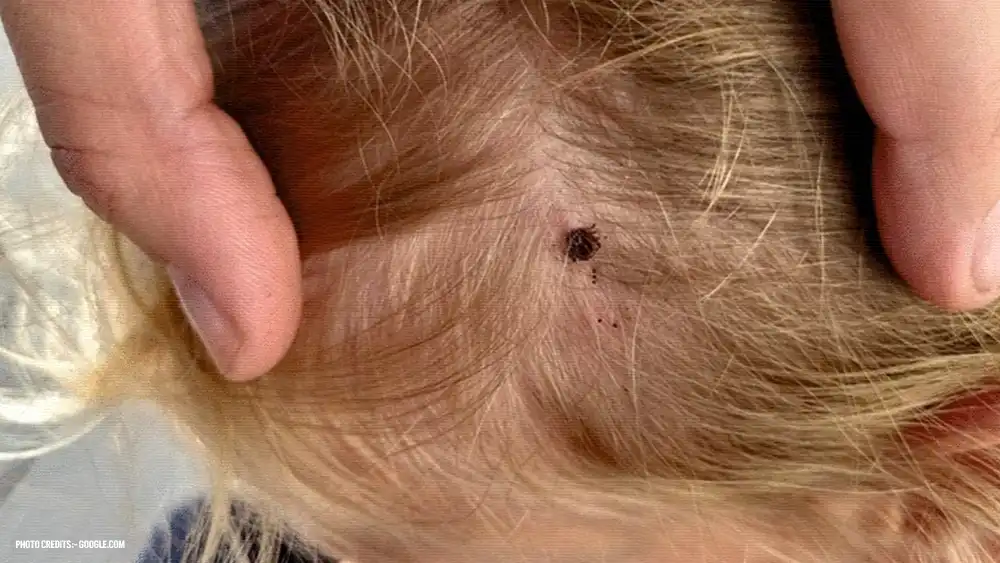 Ticks Borne Disease