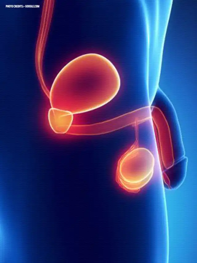 Male Hypogonadism