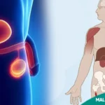 Male Hypogonadism