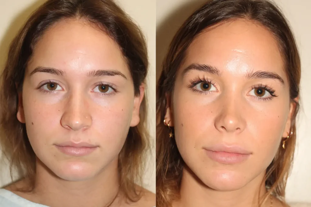 Closed Rhinoplasty Cost