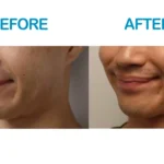 Dimples Cosmetic Surgery Before and After