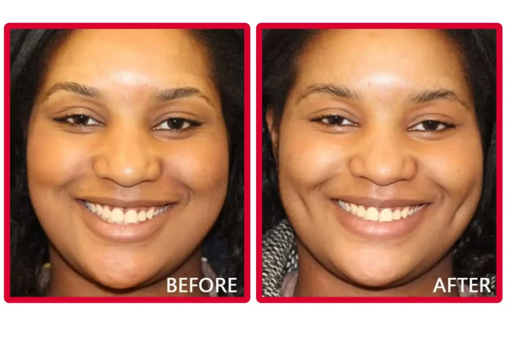 Dimples Cosmetic Surgery Before and After